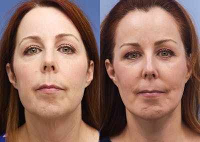 Face Before & After Gallery - Patient 618803 - Image 1