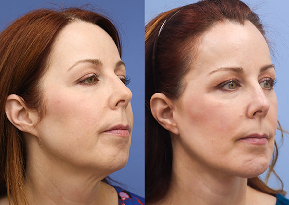 Face Before & After Gallery - Patient 618803 - Image 2