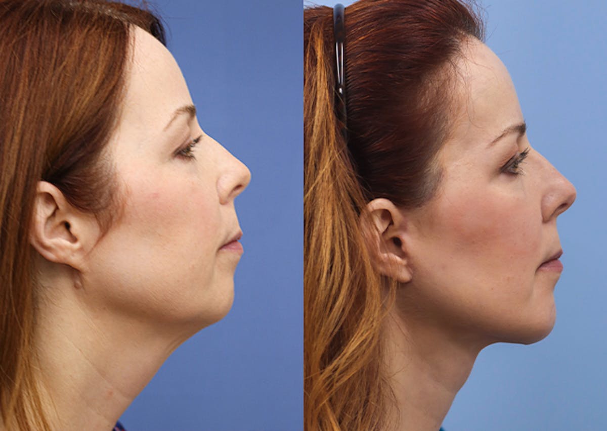 Face Before & After Gallery - Patient 618803 - Image 3