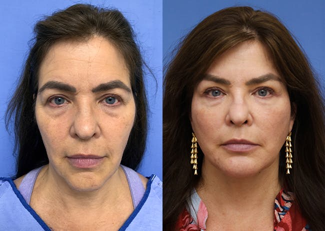 Face Before & After Gallery - Patient 211715 - Image 1