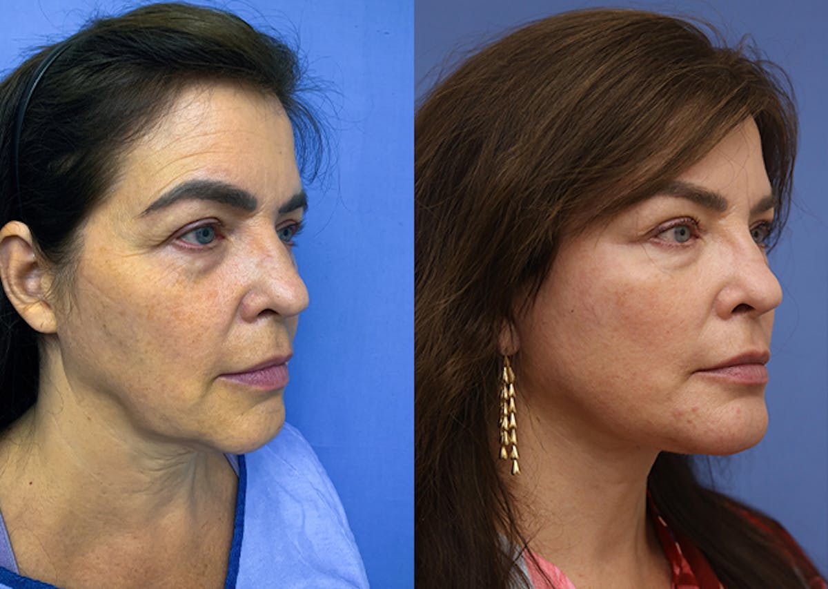 Face Before & After Gallery - Patient 211715 - Image 2