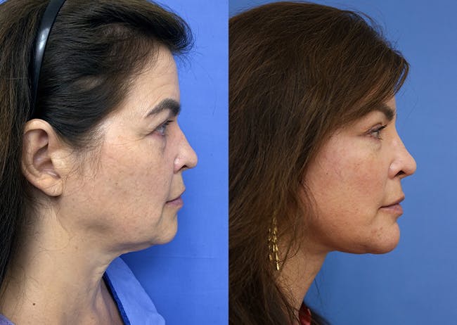 Face Before & After Gallery - Patient 211715 - Image 3
