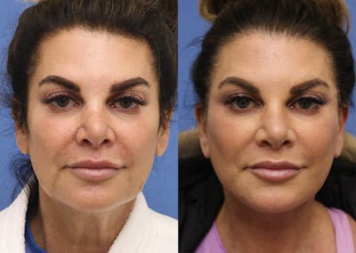 Neck Before & After Gallery - Patient 118966 - Image 1