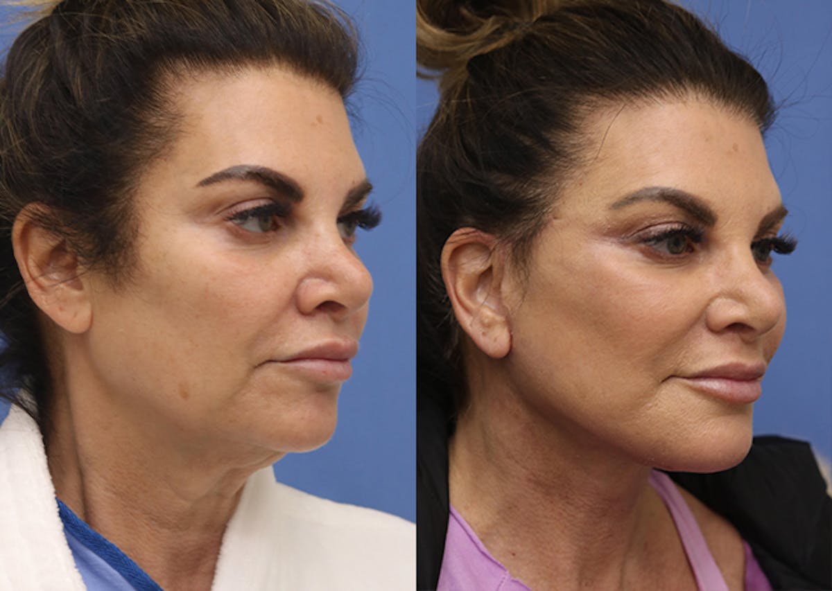 Neck Lift Before & After Gallery - Patient 209916 - Image 2