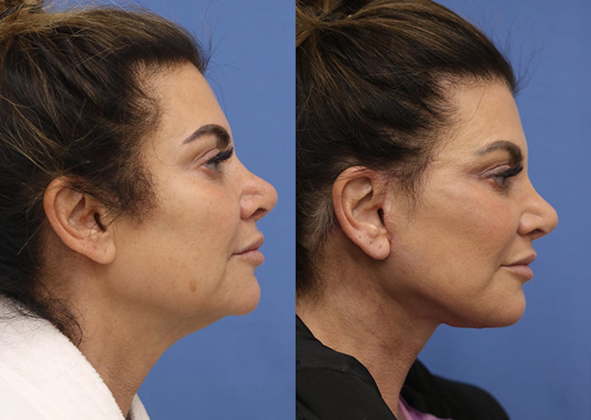 Neck Lift Before & After Gallery - Patient 209916 - Image 3