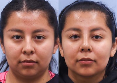 Nose Before & After Gallery - Patient 159372 - Image 1