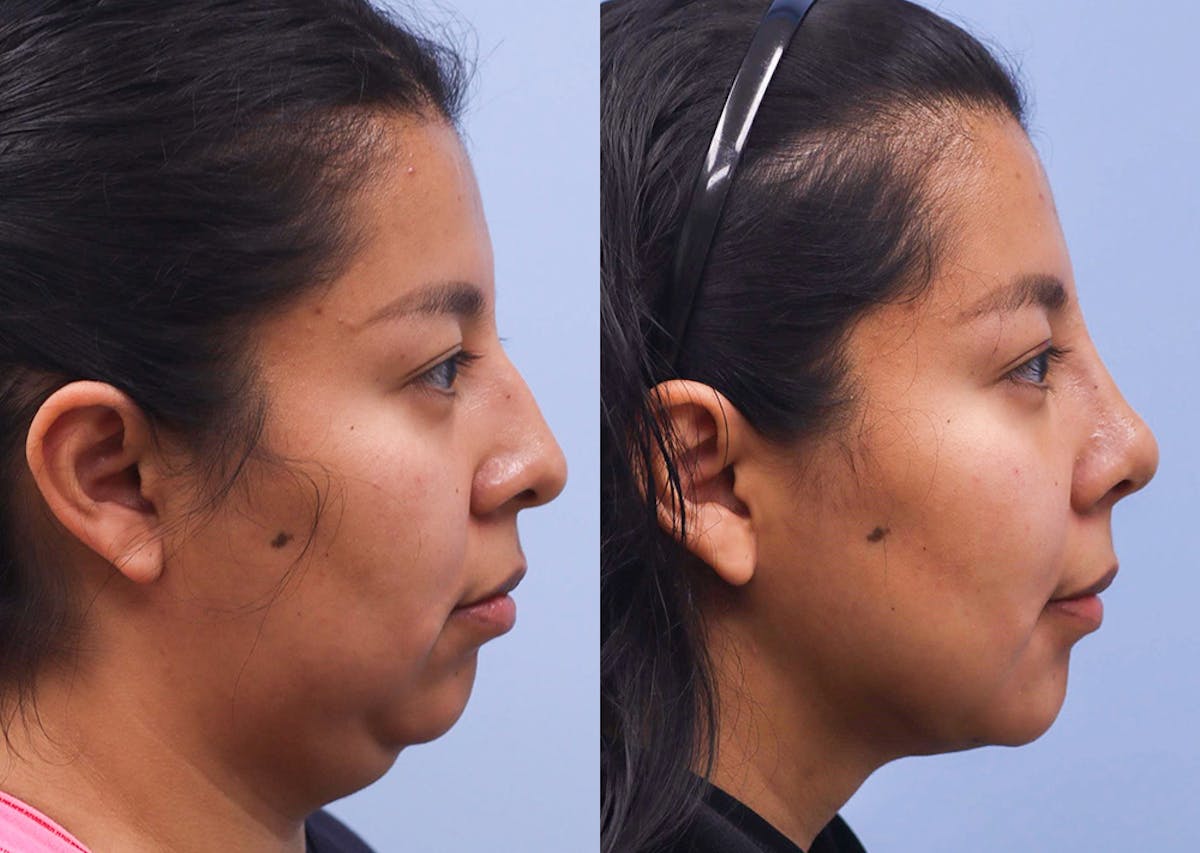 Nose Before & After Gallery - Patient 159372 - Image 3