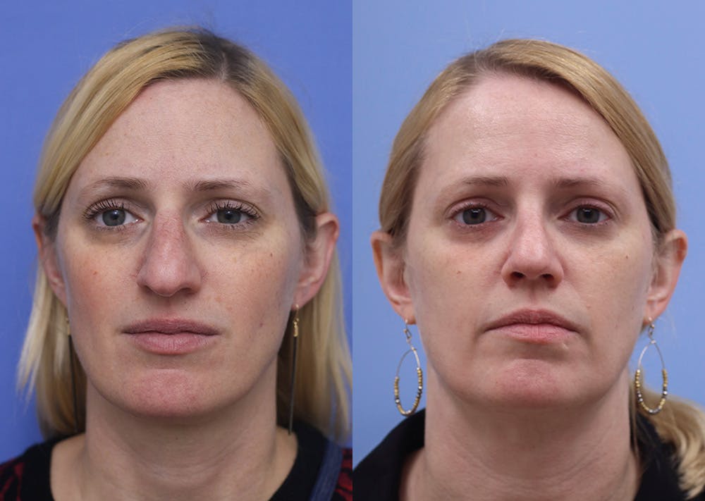 Nose Before & After Gallery - Patient 230525 - Image 1