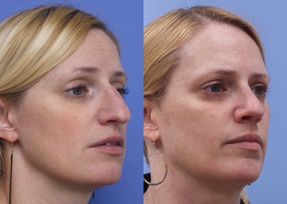 Nose Before & After Gallery - Patient 230525 - Image 2