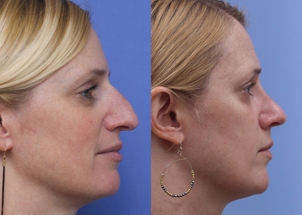 Nose Before & After Gallery - Patient 230525 - Image 3