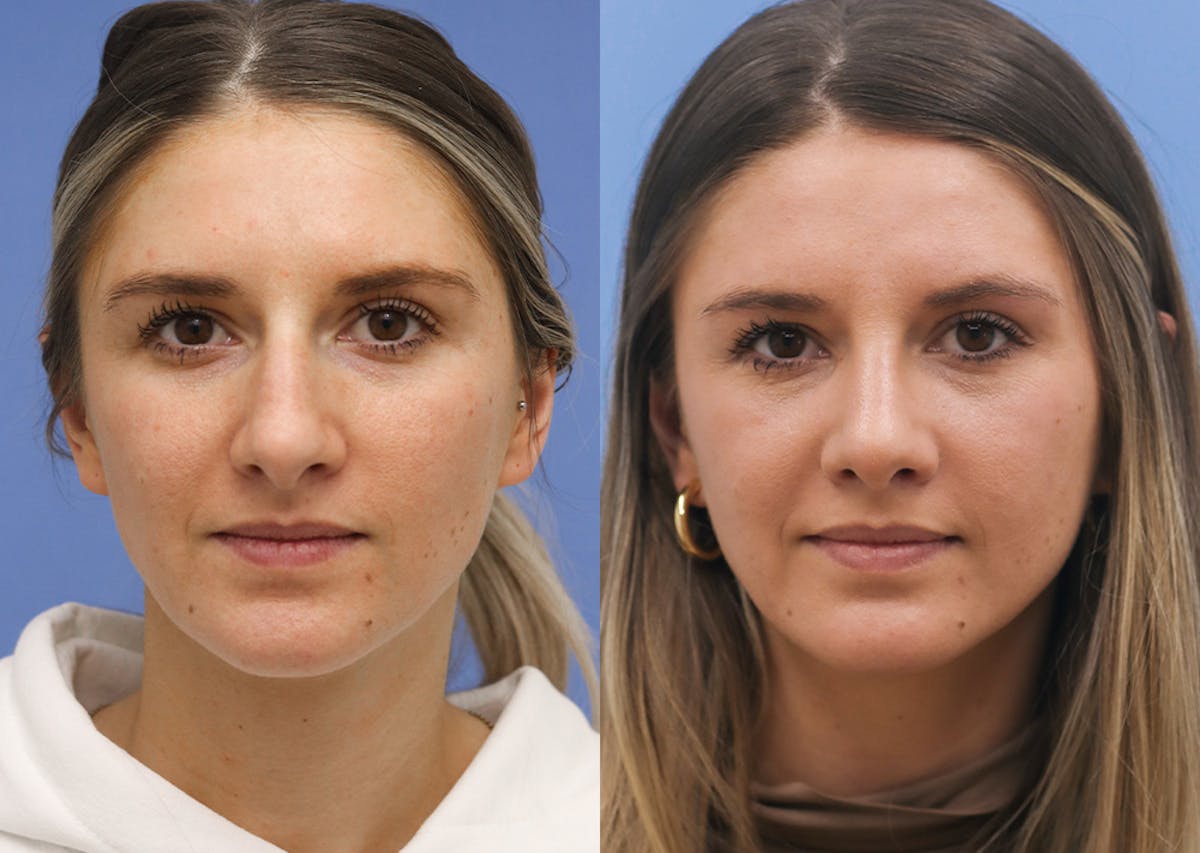 Nose Before & After Gallery - Patient 254830 - Image 1