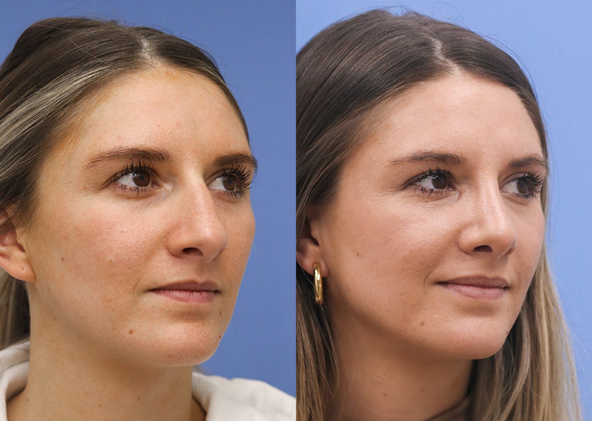 Nose Before & After Gallery - Patient 254830 - Image 2