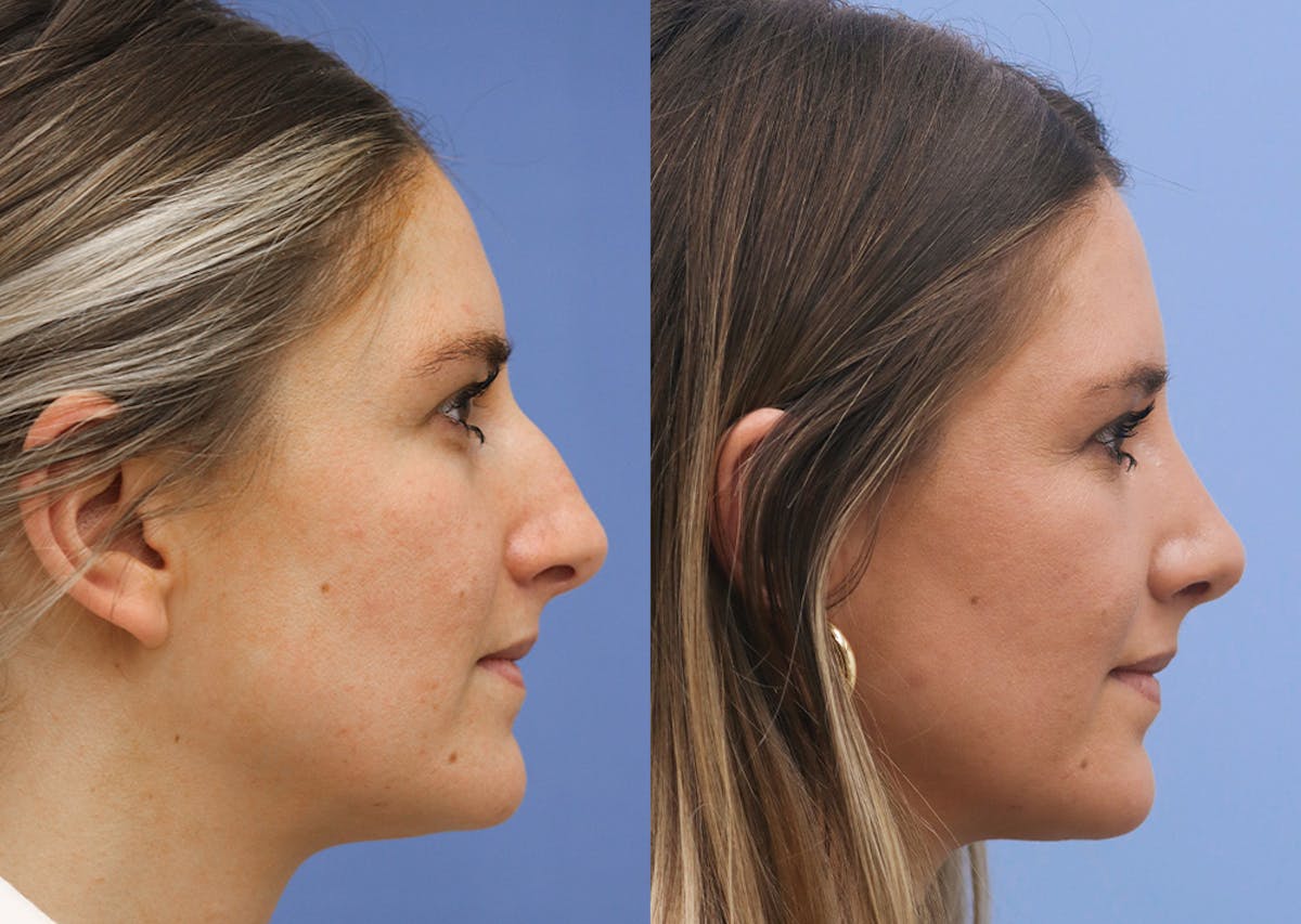 Nose Before & After Gallery - Patient 254830 - Image 3