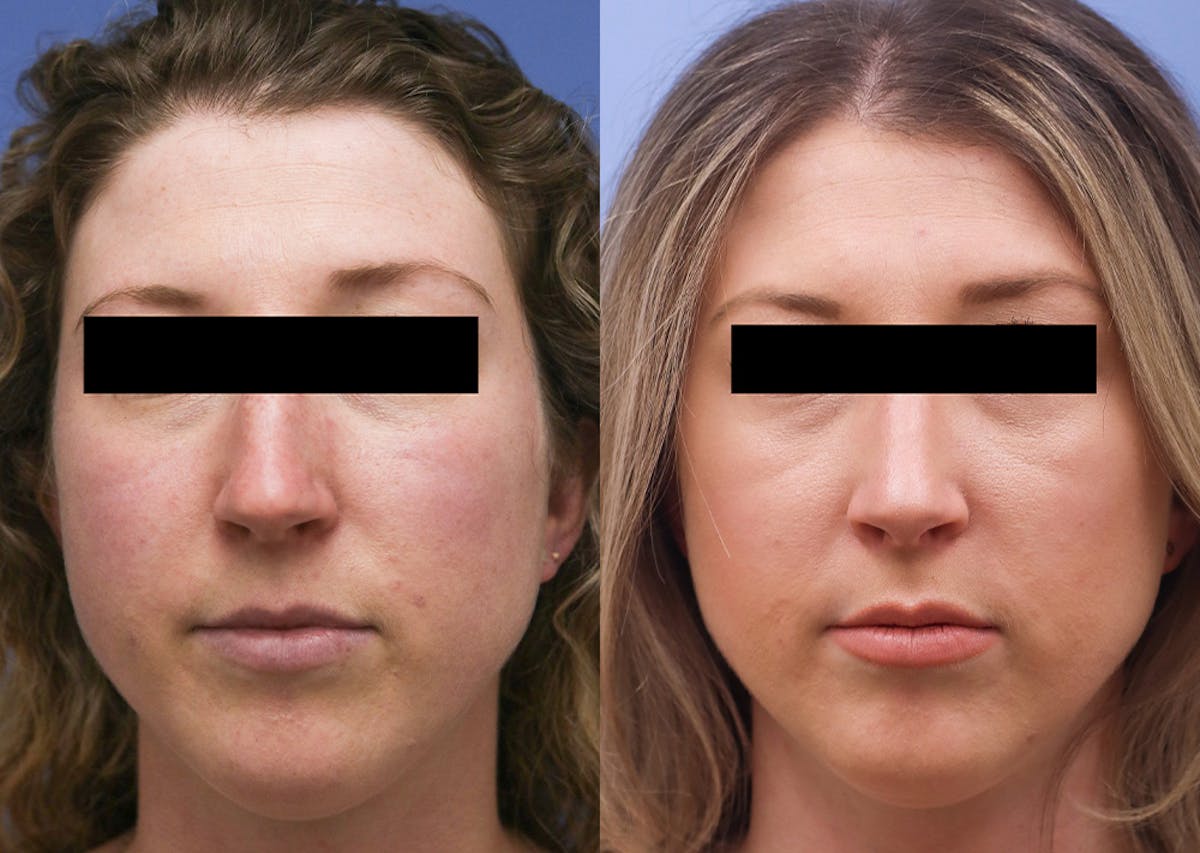 Nose Before & After Gallery - Patient 155390 - Image 1