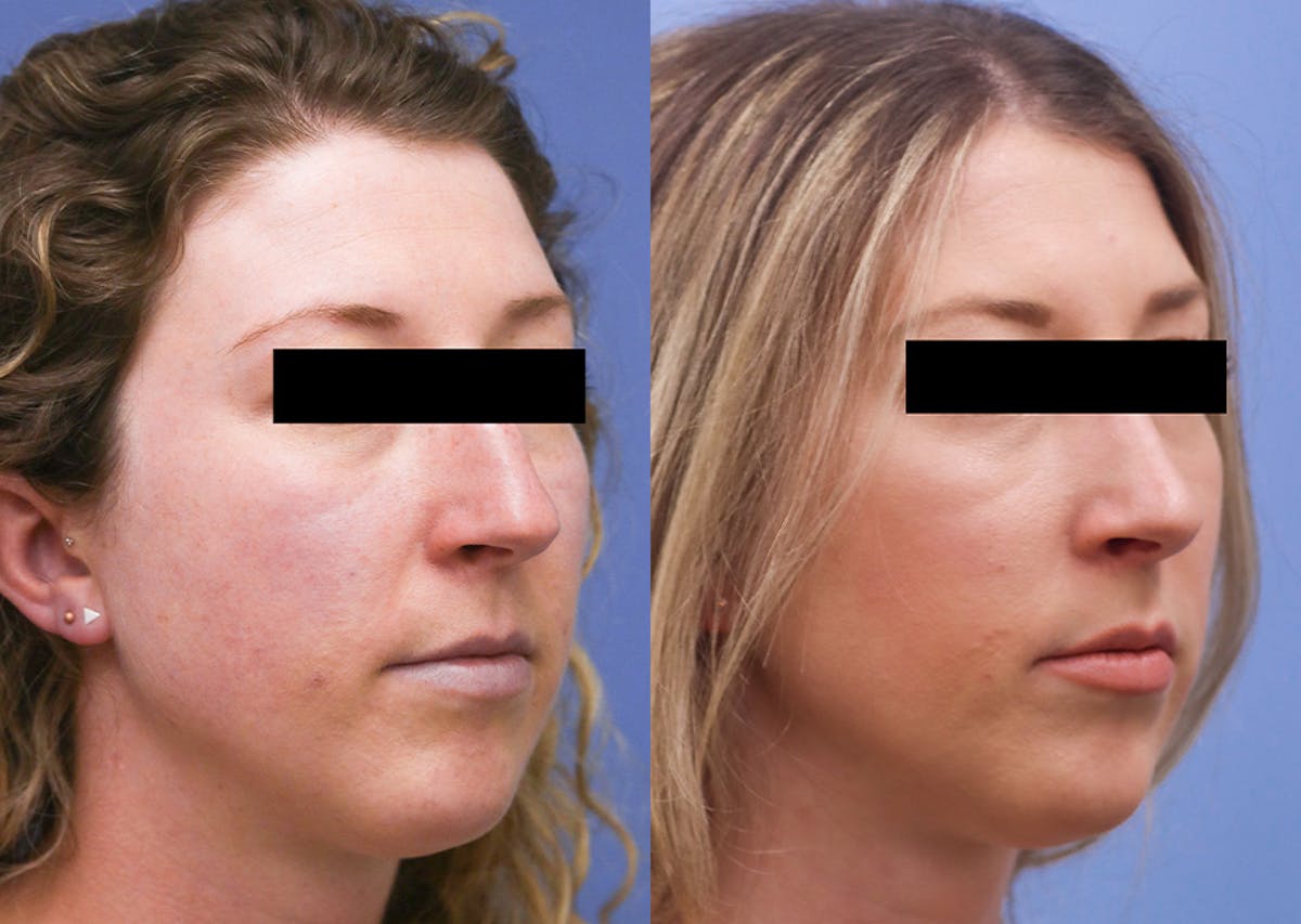 Nose Before & After Gallery - Patient 155390 - Image 2