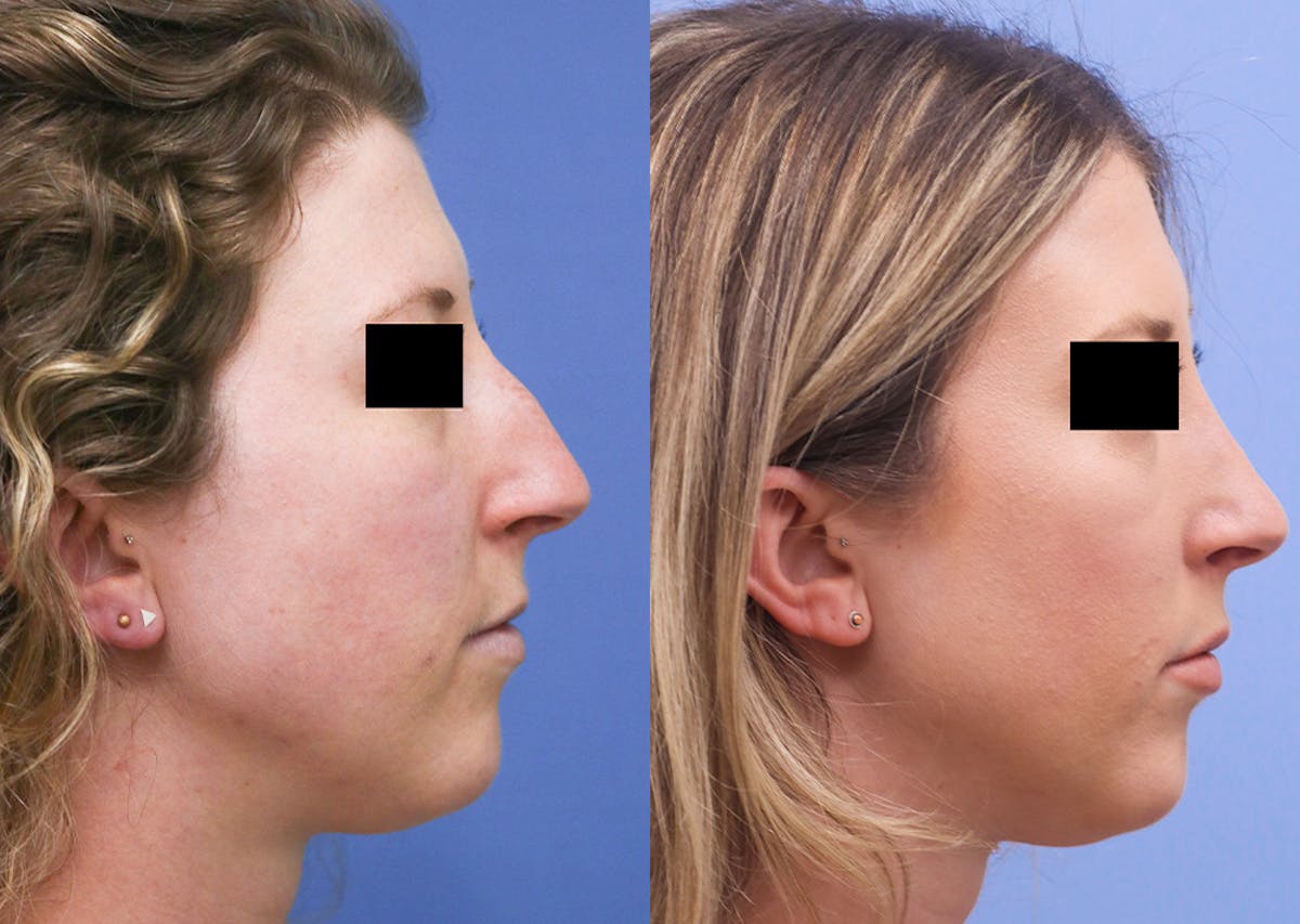 Nose Before & After Gallery - Patient 155390 - Image 3
