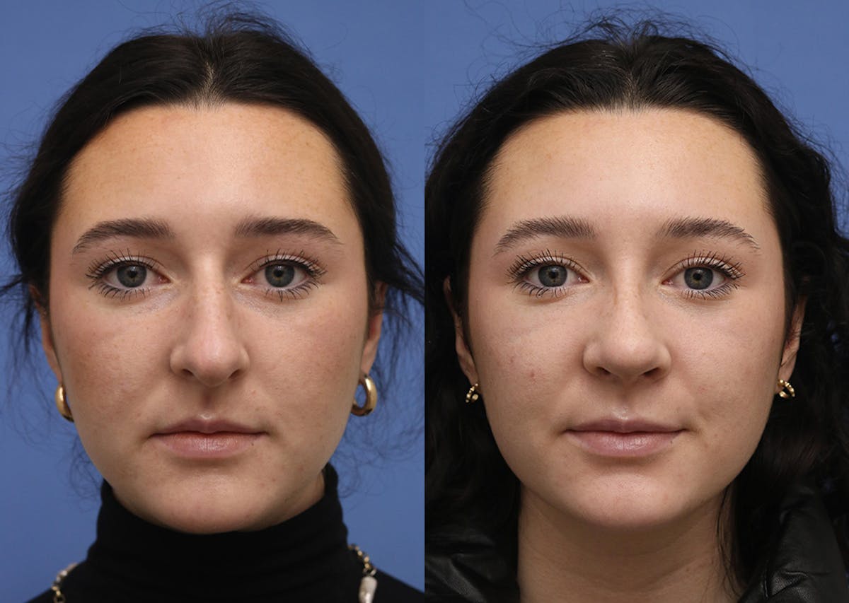 Nose Before & After Gallery - Patient 586750 - Image 1