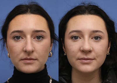 Nose Before & After Gallery - Patient 586750 - Image 1