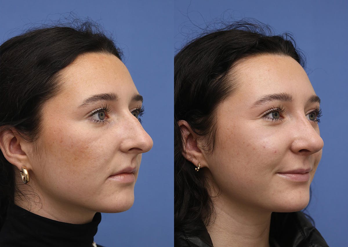 Nose Before & After Gallery - Patient 586750 - Image 2