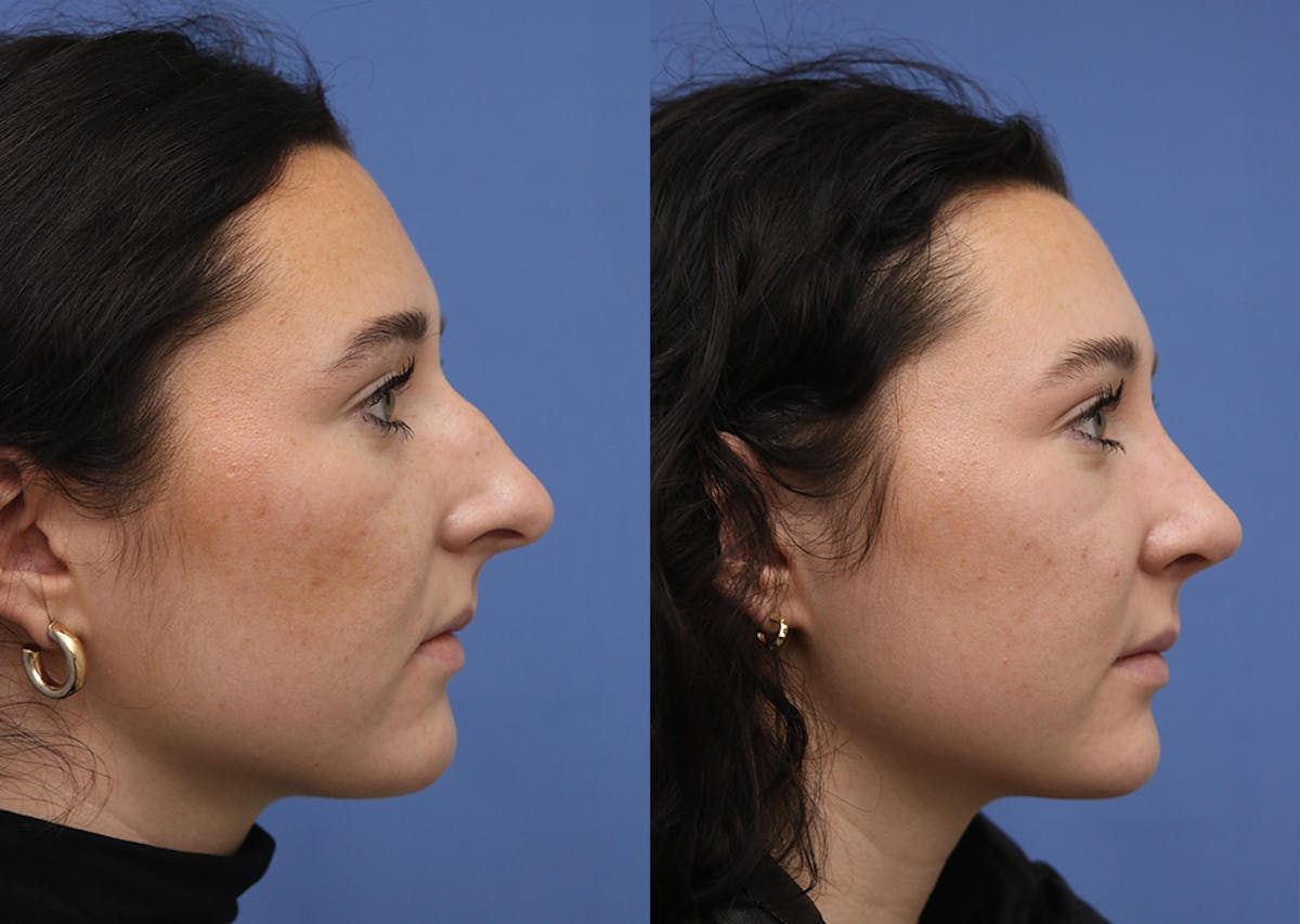 Nose Before & After Gallery - Patient 586750 - Image 3