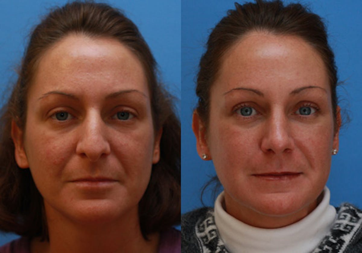 Nose Before & After Gallery - Patient 325349 - Image 1