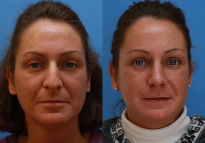Nose Before & After Gallery - Patient 325349 - Image 1