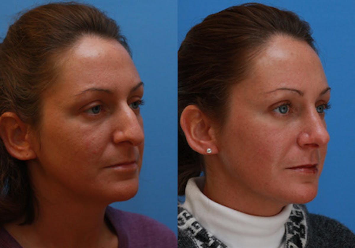 Nose Before & After Gallery - Patient 325349 - Image 2