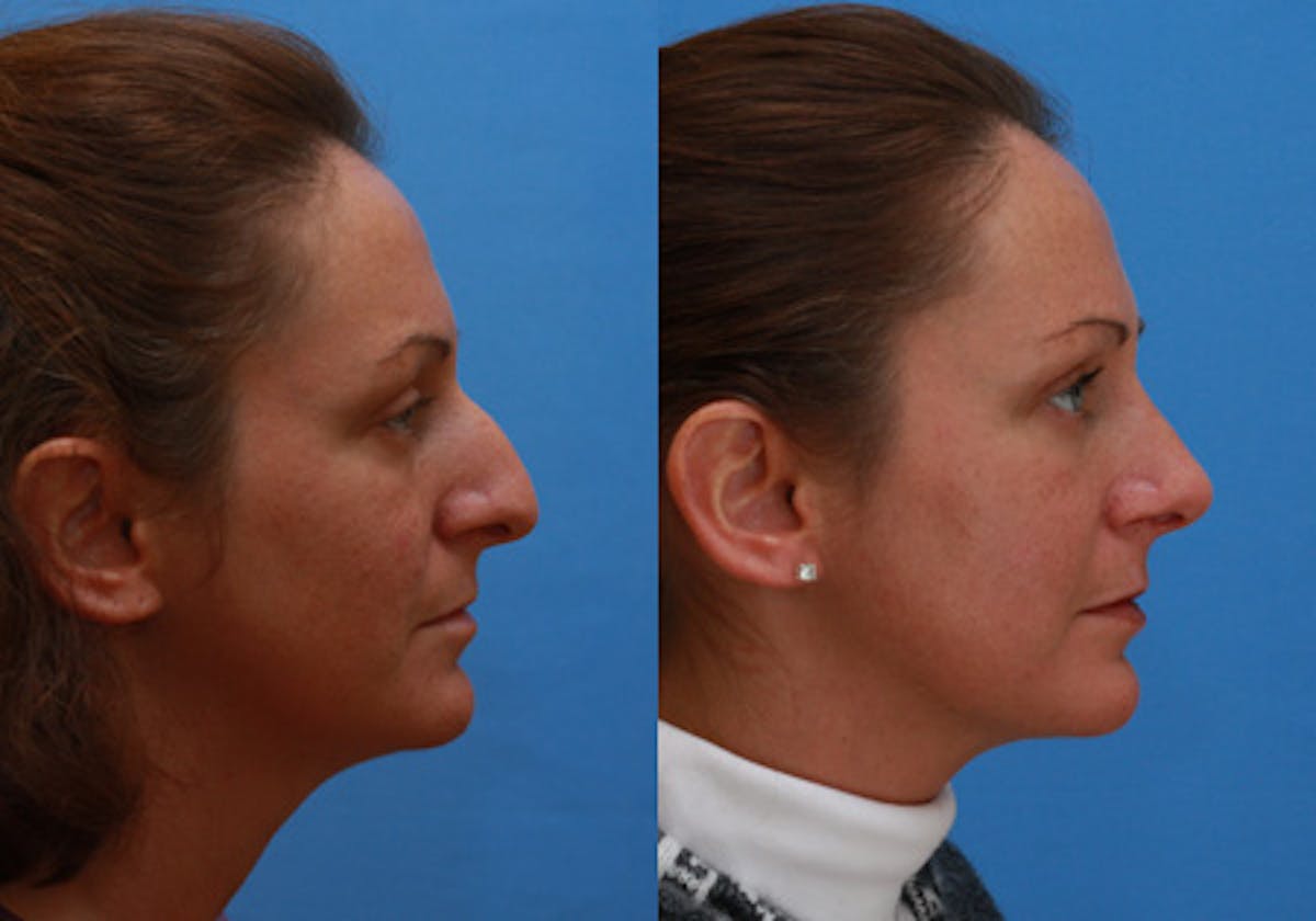 Nose Before & After Gallery - Patient 325349 - Image 3