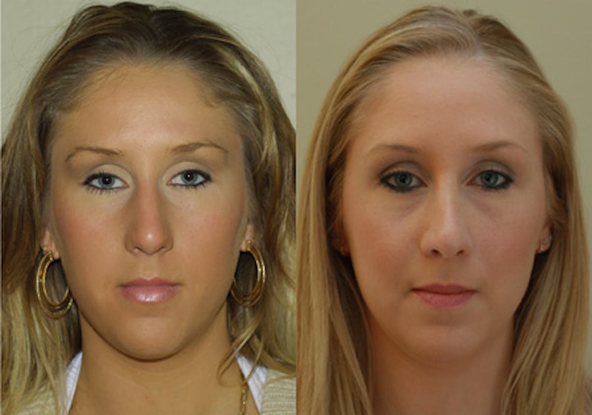Nose Before & After Gallery - Patient 389369 - Image 1