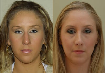 Nose Before & After Gallery - Patient 389369 - Image 1