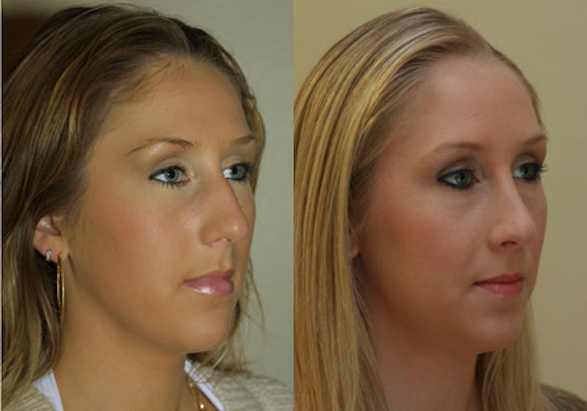 Nose Before & After Gallery - Patient 389369 - Image 2