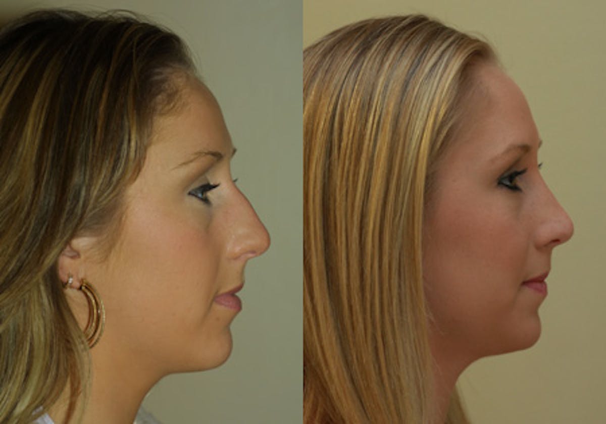 Nose Before & After Gallery - Patient 389369 - Image 3