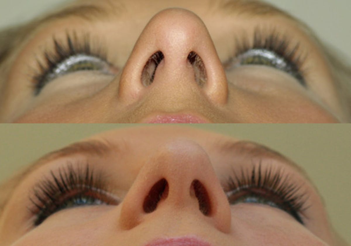 Nose Before & After Gallery - Patient 389369 - Image 4