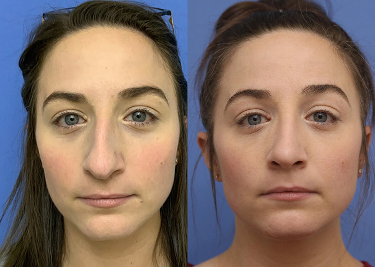 Nose Before & After Gallery - Patient 172776 - Image 1