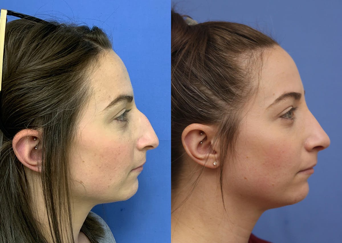Nose Before & After Gallery - Patient 172776 - Image 2