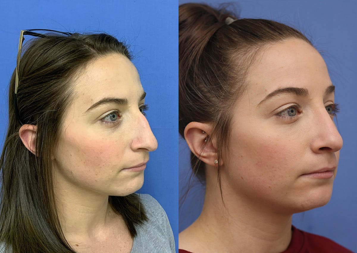 Nose Before & After Gallery - Patient 172776 - Image 3