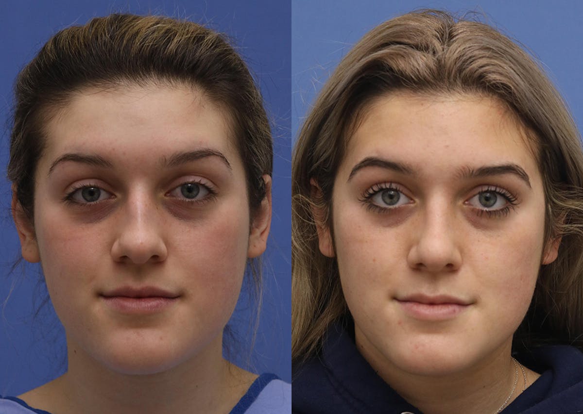 Nose Before & After Gallery - Patient 230508 - Image 1