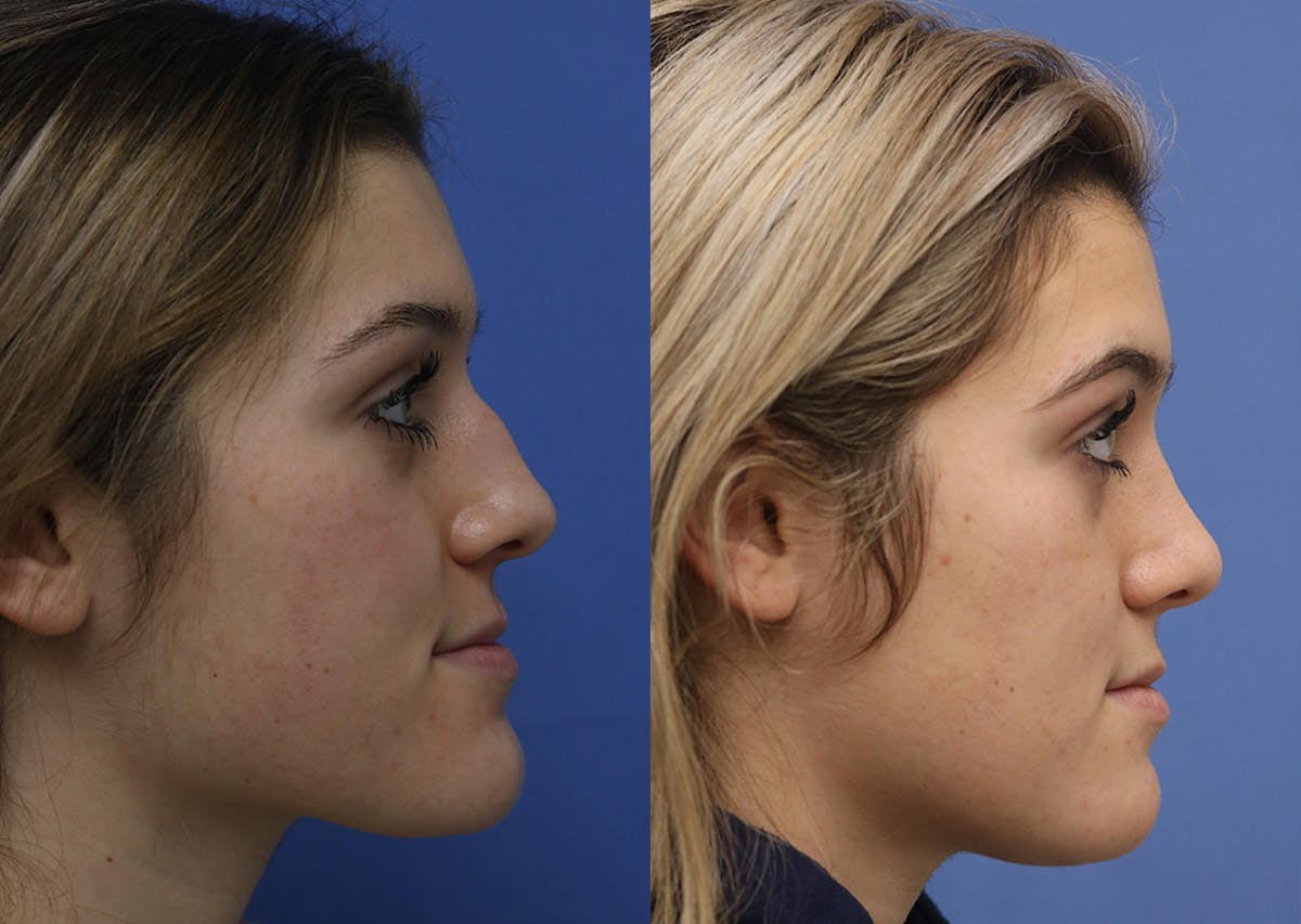 Nose Before & After Gallery - Patient 230508 - Image 3
