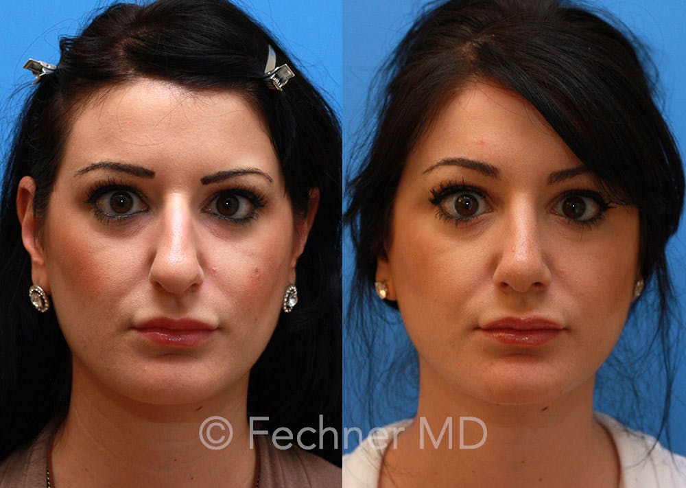 Nose Before & After Gallery - Patient 218821 - Image 1