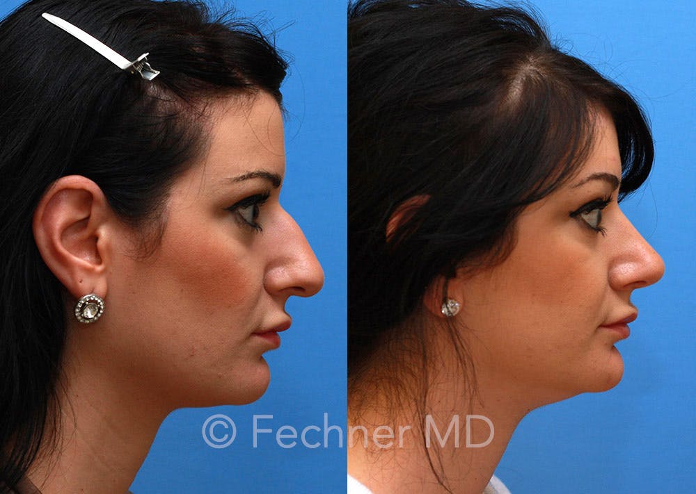 Nose Before & After Gallery - Patient 218821 - Image 2