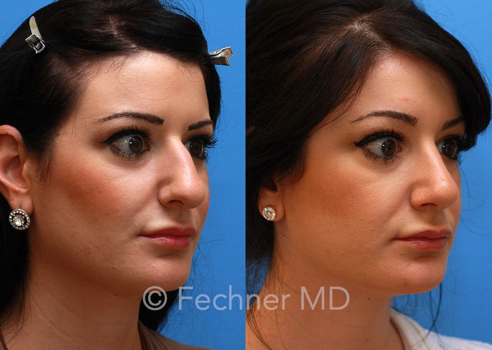 Nose Before & After Gallery - Patient 218821 - Image 3