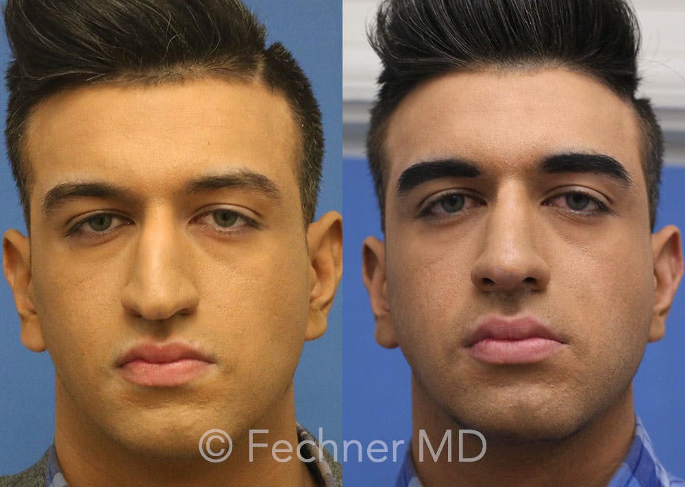Nose Before & After Gallery - Patient 346048 - Image 1