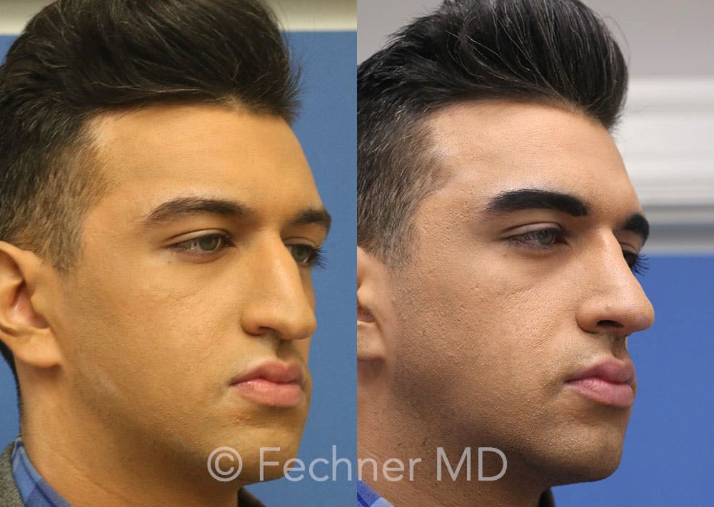 Nose Before & After Gallery - Patient 346048 - Image 2