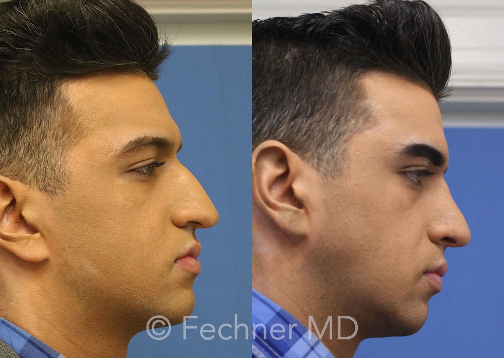 Nose Before & After Gallery - Patient 346048 - Image 3