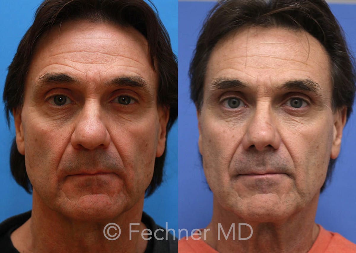 Nose Before & After Gallery - Patient 296384 - Image 1