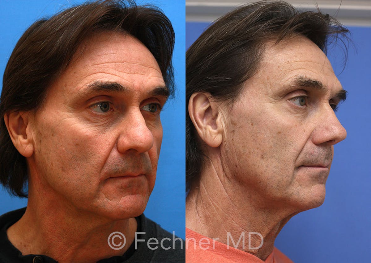 Nose Before & After Gallery - Patient 296384 - Image 2