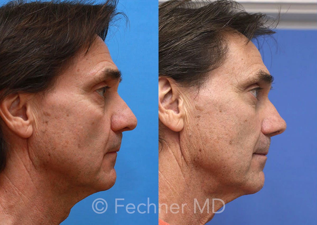 Nose Before & After Gallery - Patient 296384 - Image 3