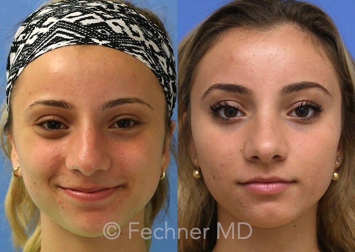 Nose Before & After Gallery - Patient 250839 - Image 1