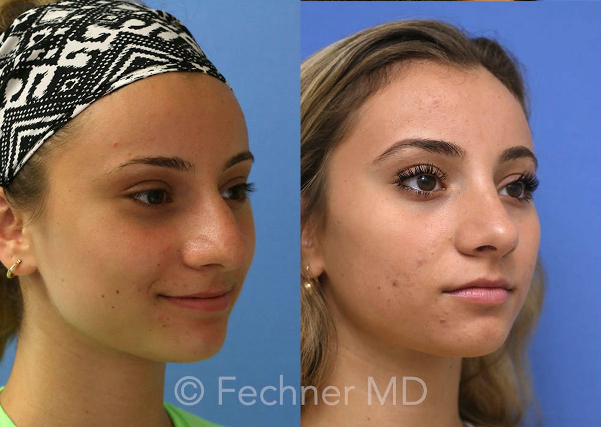 Nose Before & After Gallery - Patient 250839 - Image 2