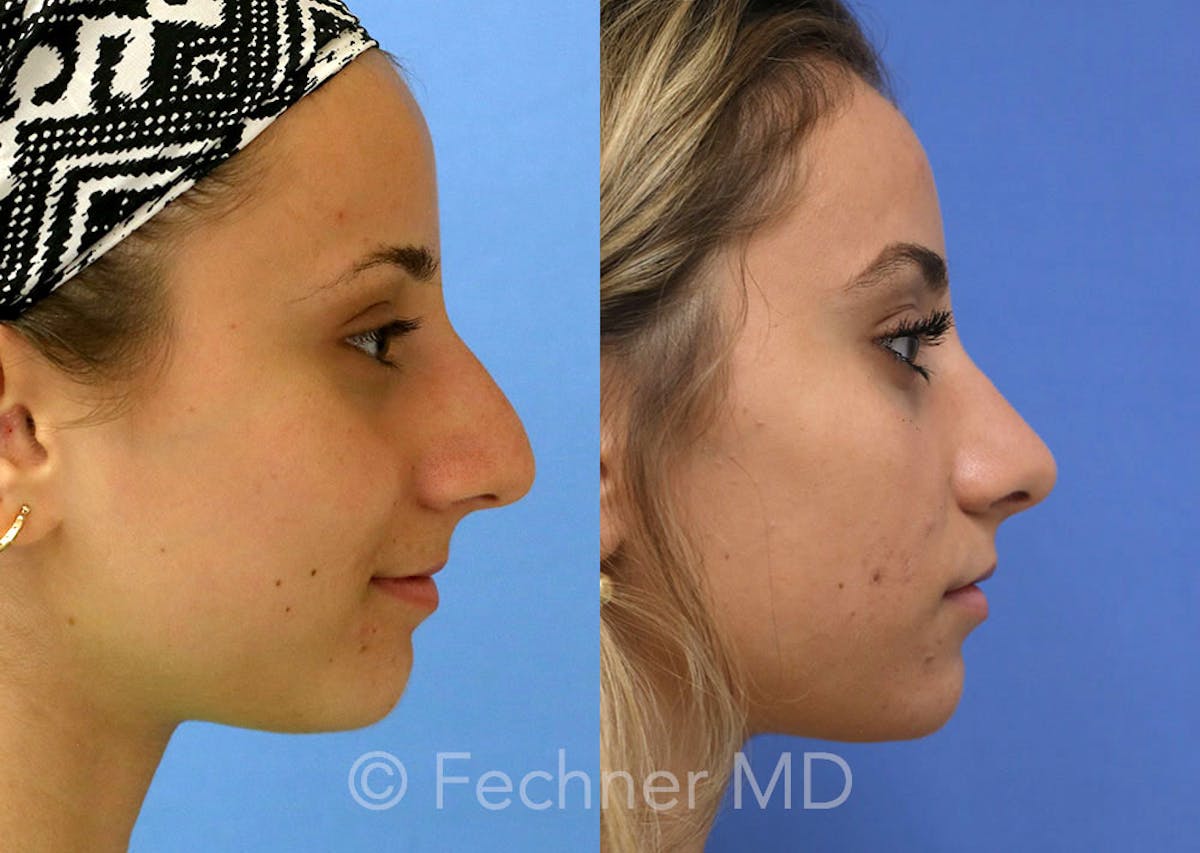 Nose Before & After Gallery - Patient 250839 - Image 3